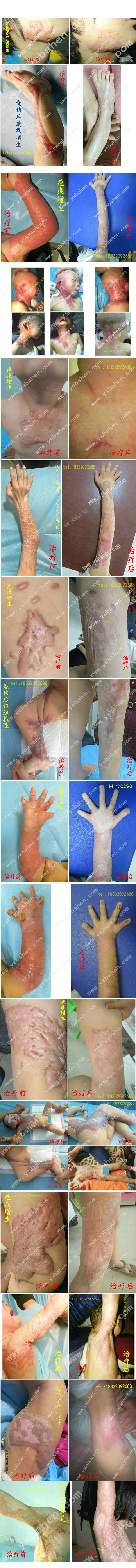 <b>疤痕组织增生及粘连</b>