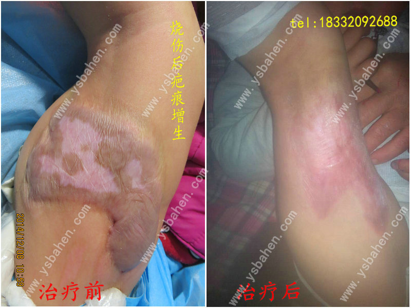 <b>疤痕增生及牵拉13</b>