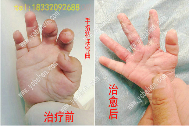 手指挛缩畸形3