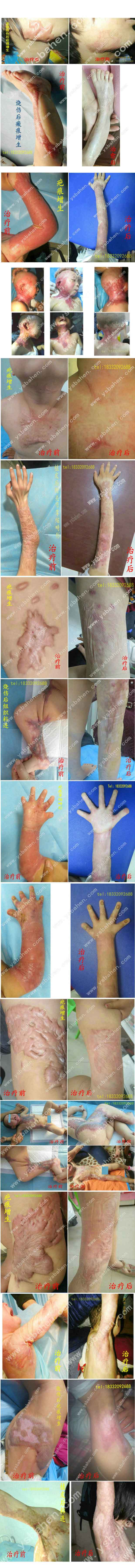不植皮治疗手指粘连畸形